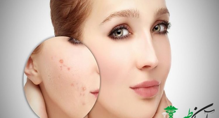 از بین بردن جوش