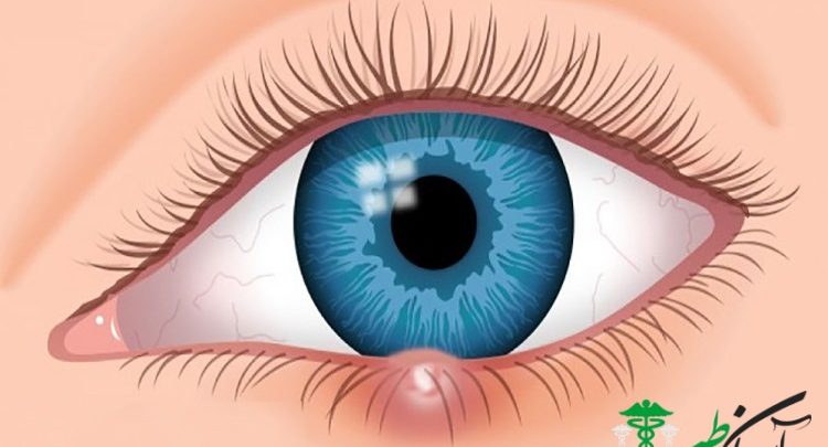 پیشگیری از گل مژه