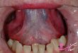 علائم شایع سرطان دهان و چگونگی تشخیص آن؛ 2 ویدیو