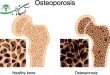 علایم بیماری پوکی استخوان و درمان آن