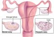 سندرم تخمدان پلی کیستیک (علائم و درمان)