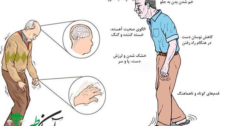 عوارض بیماری پارکینسون