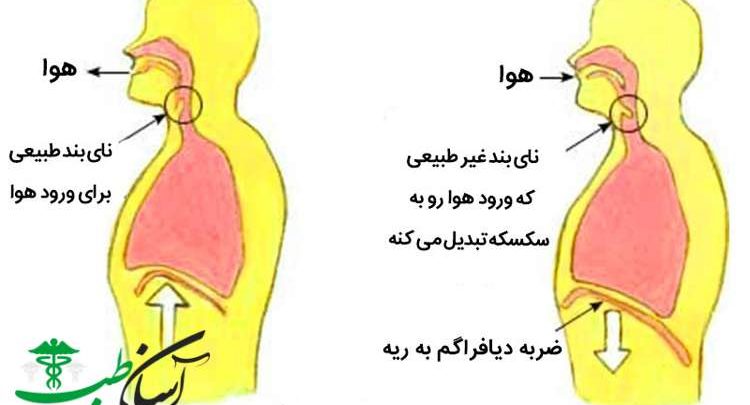 درمان سکسکه