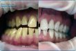راه های بلیچینگ دندان و عوارض