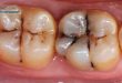 پوسیدگی دندان ها و برخی علتها