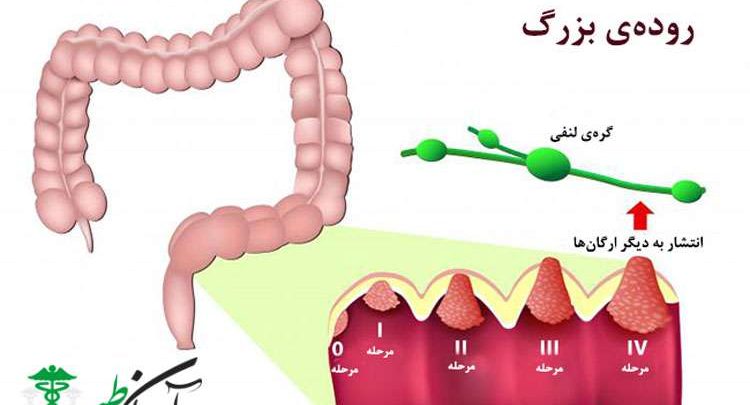 پیشگیری از سرطان روده بزرگ