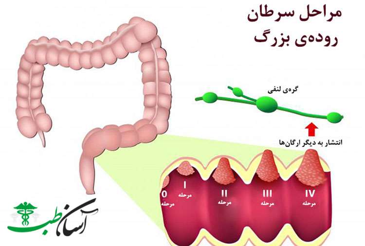 پیشگیری از سرطان روده بزرگ