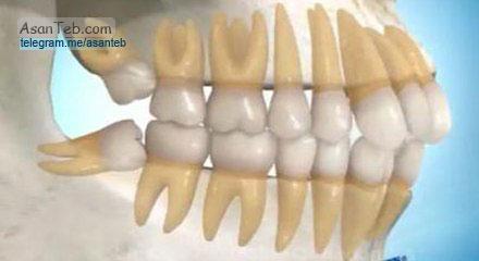 دندان عقل چیست و درد دندان عقل