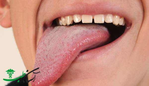 سوزش زبان و دهان