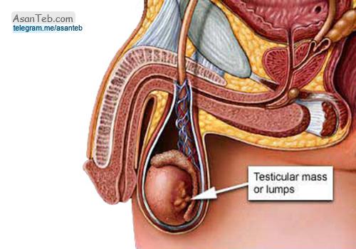 سرطان بیضه