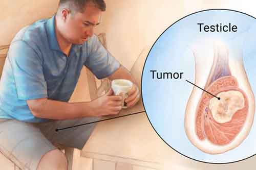 علت سرطان بیضه