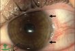 کراتیت چشم و بهترین روش های درمان التهاب قرنیه