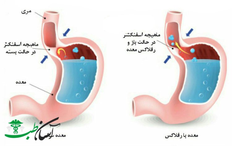 درمان ترش کردن معده