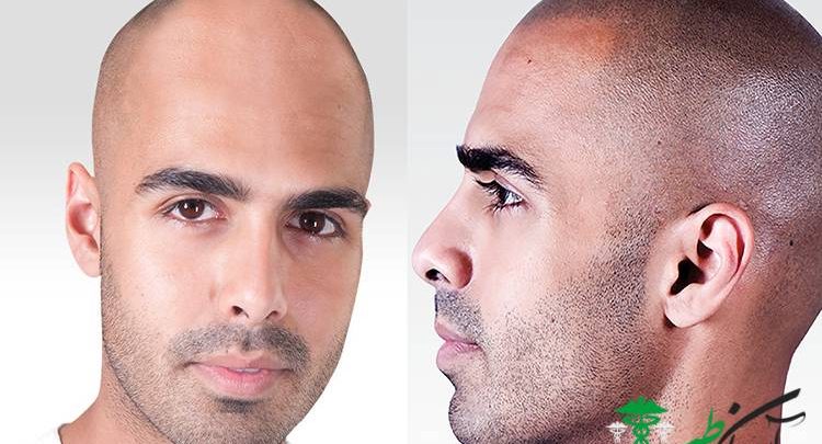 میکرواسکالپ