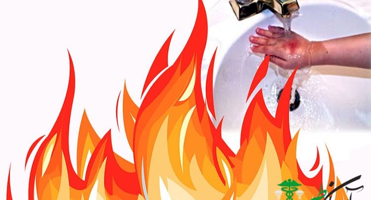 سوختگی