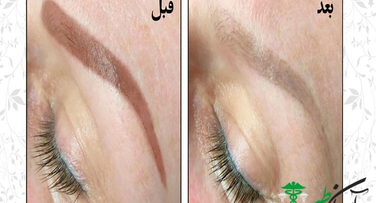 ریموو تاتو