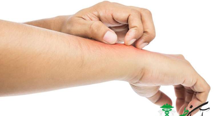 آلرژی نیکل
