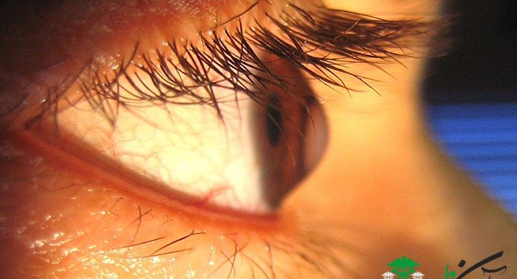 قوز قرنیه