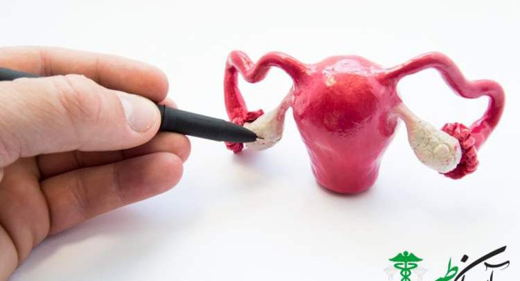 پیچ خوردگی تخمدان