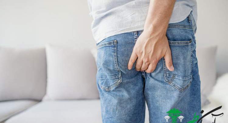 هموروئید خارجی