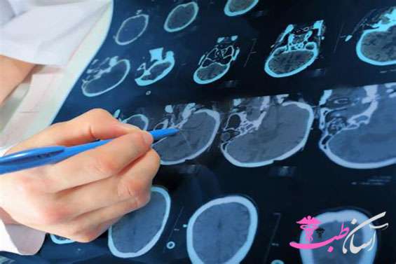 مشکلات بینایی