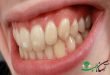 روش‌های درمان لکه‌های سفید روی دندان