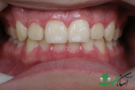 لکه‌های سفید روی دندان