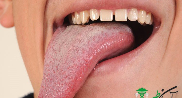 نشانه ‌های بیماری ایدز در دهان